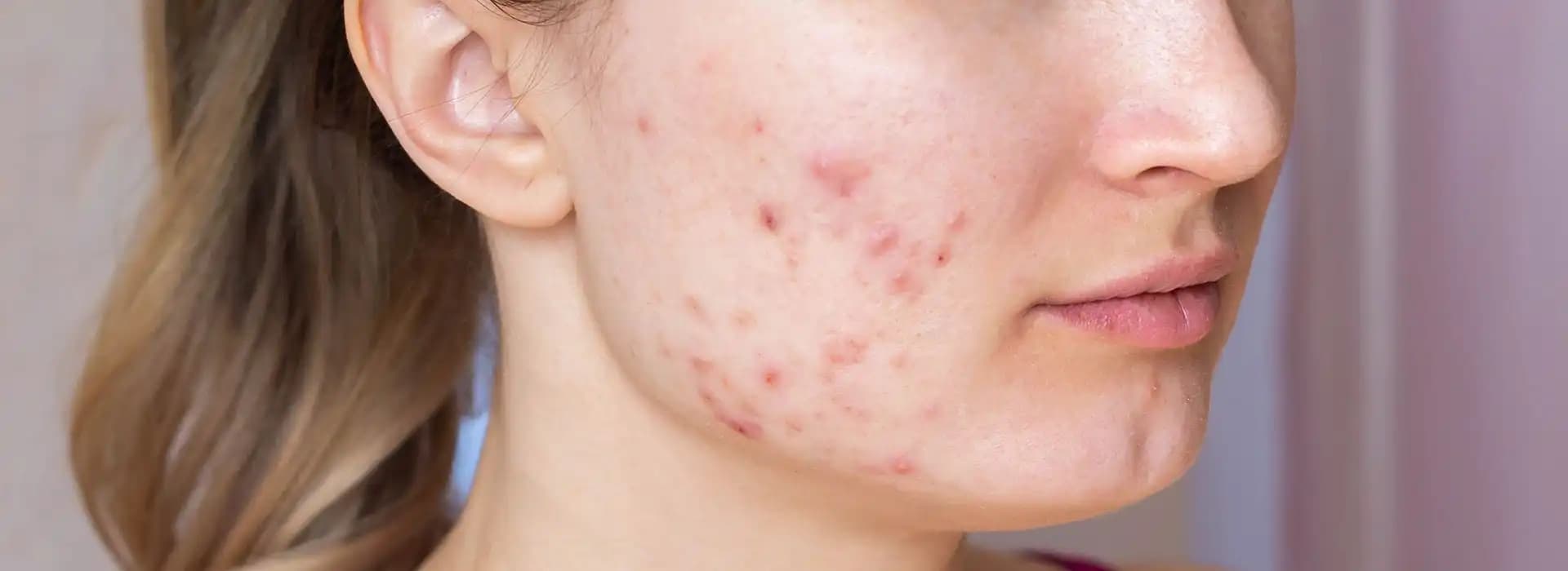 Büyük Akne Nedir, Nedenleri ve Etkili Tedavi Yöntemleri Hakkında Detaylı Bilgi