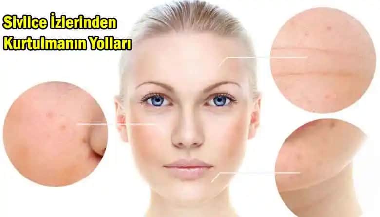 Büyük Sivilceleri Azaltmak ve Cilt Sağlığını Koruma Yöntemleri