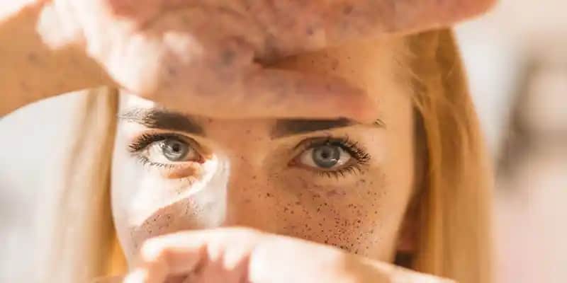 C vitamini güneş lekelerine neden olur mu bilimsel gerçekler ve cilt bakımı önerileri