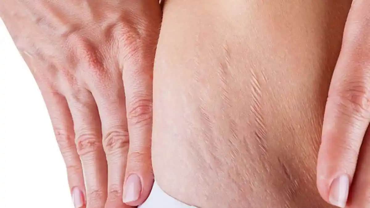 Çatlak Oluşumunu Engellemek İçin Kozmetik ve Sağlıklı Yaşam Yaklaşımları