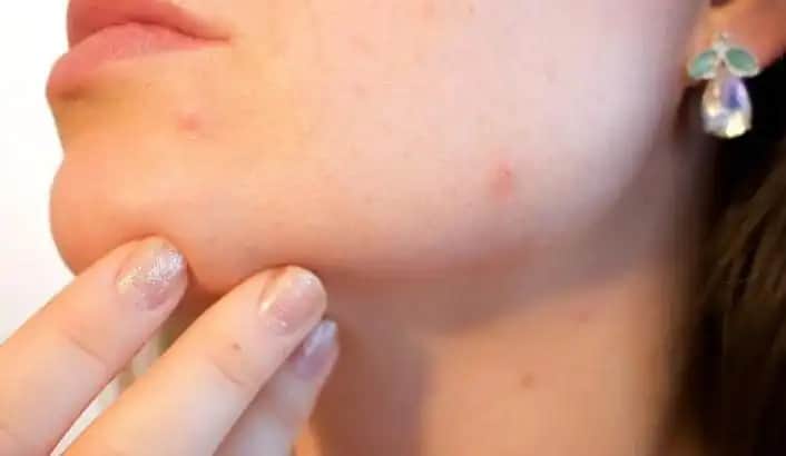 Çene Bölgesinde Sivilce Nasıl Geçer: Etkili Tedavi Yöntemleri ve Bakım İpuçları