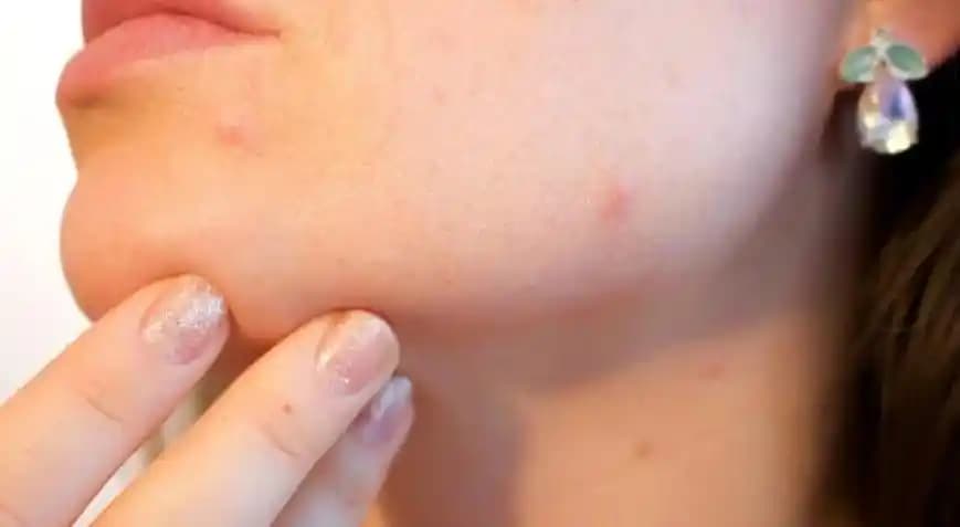 Çene Bölgesinde Sivilce Nedenleri ve Etkili Çözüm Yolları Hakkında Bilmeniz Gerekenler