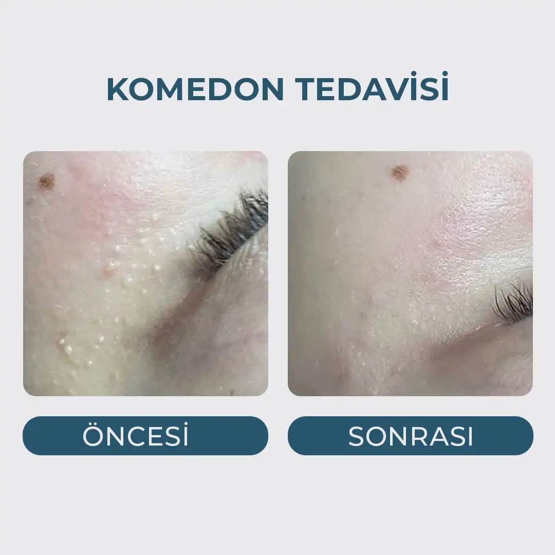 Çenede Komedonlar: Nedenleri, Özellikleri ve Etkili Tedavi Yöntemleri