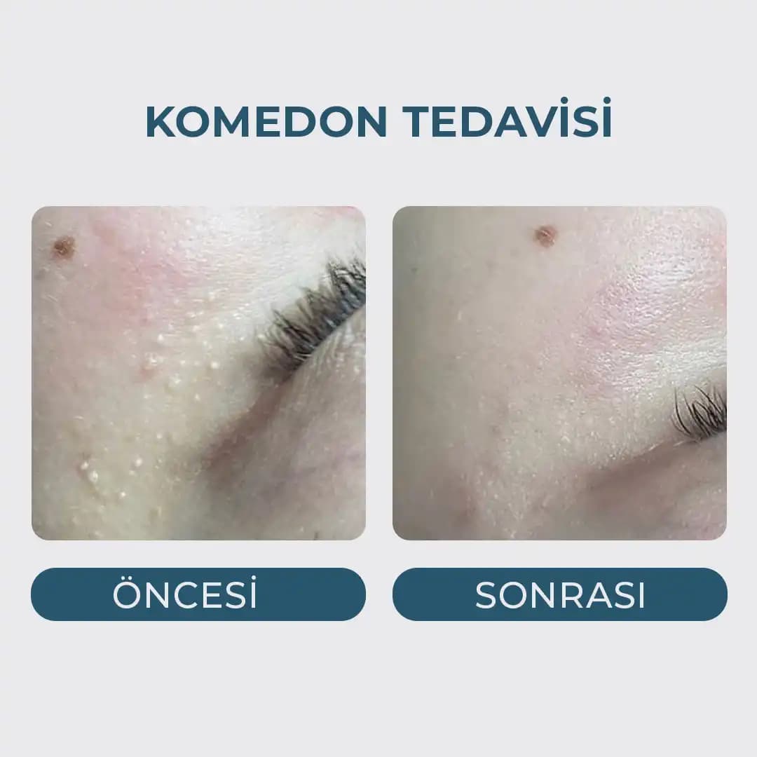 Çenede Komedonlar: Nedenleri, Özellikleri ve Etkili Tedavi Yöntemleri