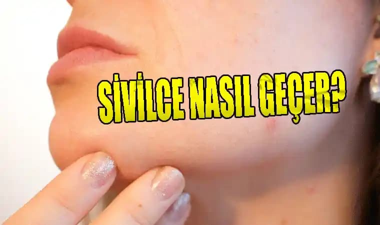 Çenedeki Sivilce Lekeleri Nasıl Geçer Güncel ve Etkili Çözüm Yöntemleri