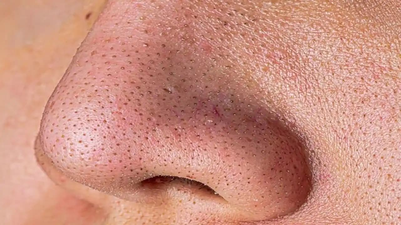 Çenedeki Siyah Noktalar Nasıl Geçer: Etkili ve Kalıcı Çözüm Yöntemleri