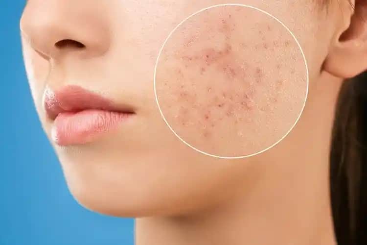 Çıkmak Üzere Olan Sivilceler ve Etkili Önleme Yöntemleri