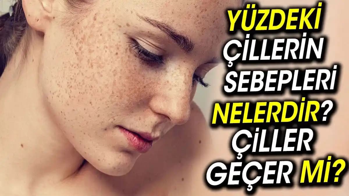 Çiller Geçer mi? Güneş ve Genetik Faktörler Işığında Cilt Renk Değişiklikleri