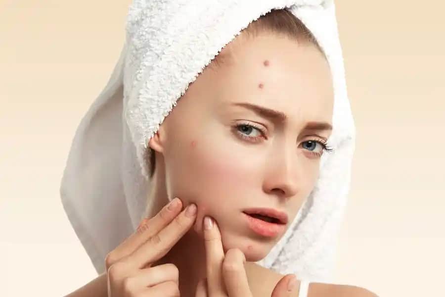 Cilt Aknesiyle Mücadelede Etkili Kozmetik Yaklaşımlar ve Doğal Çözümler