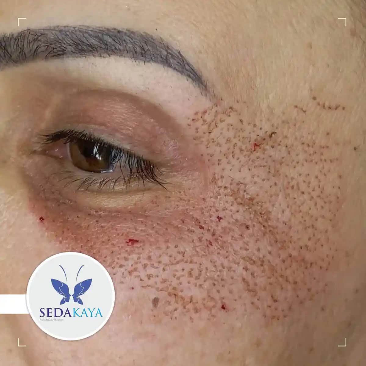 Cilt Kabuklanması Nedenleri ve Çözüm Yolları Hakkında Detaylı Bilgi