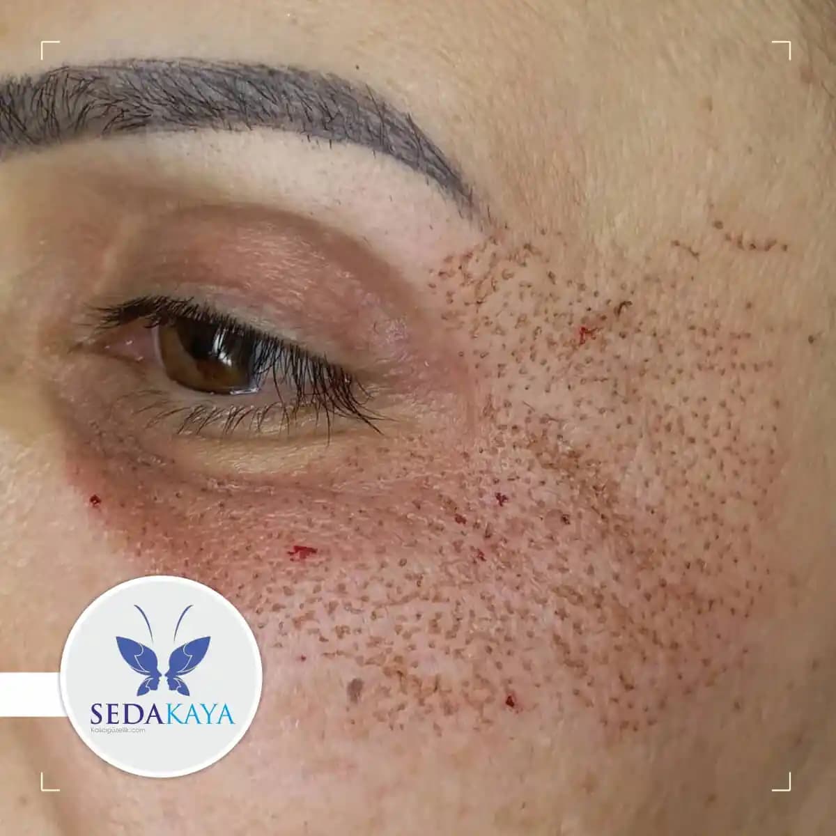 Cilt Kabuklanması Nedenleri ve Çözüm Yolları Hakkında Detaylı Bilgi