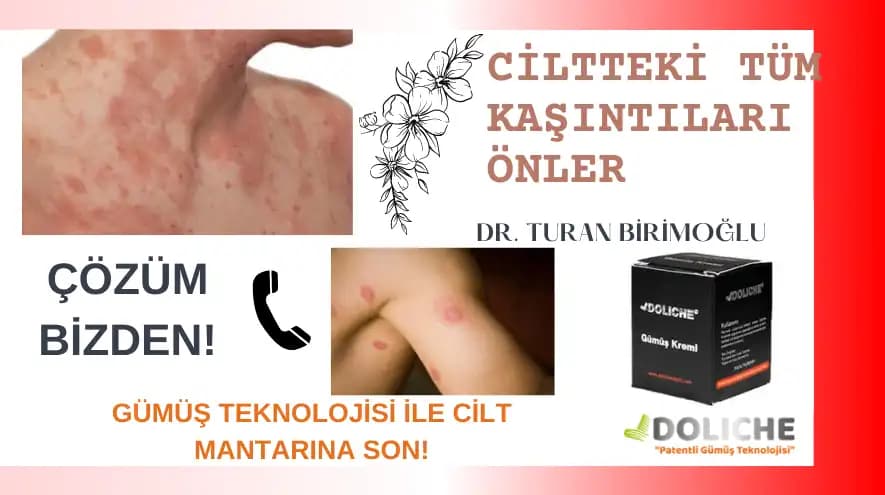 Cilt Mantarı İçin Doğal Tedavi Yöntemleri: Bitkisel ve Evde Uygulanabilir Çözümler