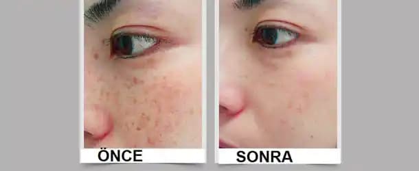 Cilt Pigmentasyonu Nedir, Nedenleri ve Etkili Tedavi Yöntemleri Hakkında Kapsamlı Bilgi