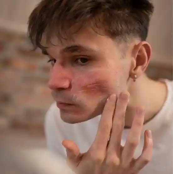 Cilt Tahrişi Nedenleri Belirtileri ve Korunma Yöntemleri Hakkında Kapsamlı Bilgi