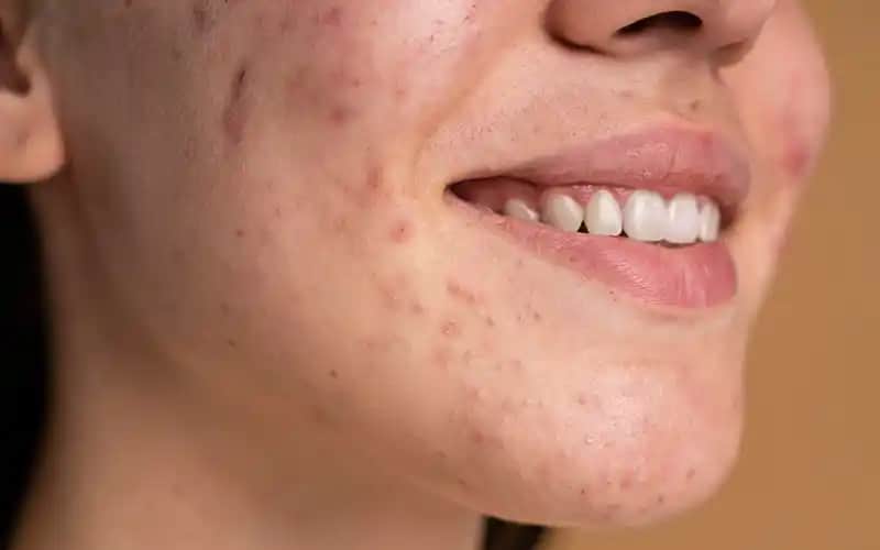 Ciltte Akneyle Mücadele: Etkili Bakım ve Koruma Yöntemleri Hakkında Kapsamlı Rehber