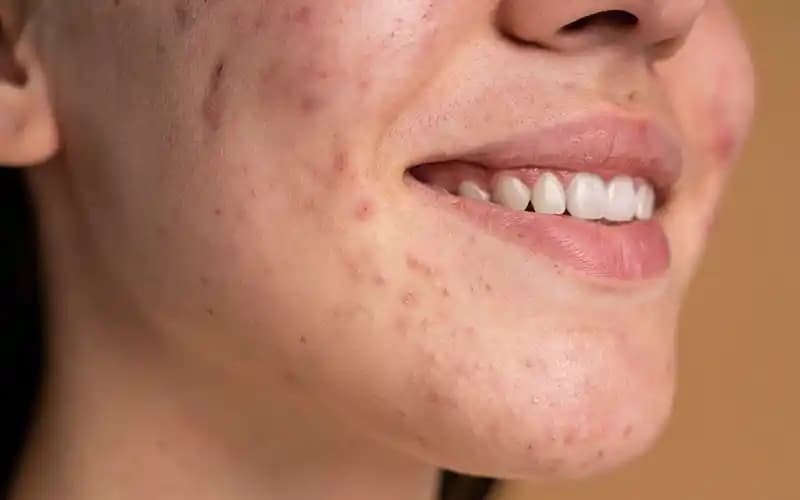 Ciltte Akneyle Mücadele: Etkili Bakım ve Koruma Yöntemleri Hakkında Kapsamlı Rehber