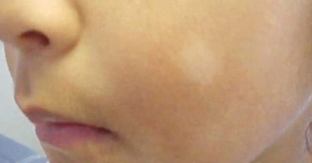 Ciltte Beyaz Nokta Nedenleri, Tedavi Yöntemleri ve Güzellik İpuçları