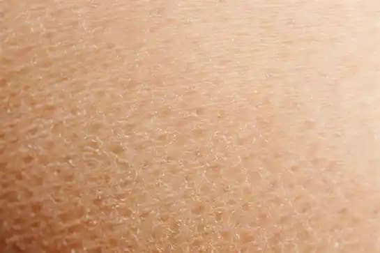 Ciltte Beyaz Pullanma Nedenleri, Önleme Yöntemleri ve Doğal Tedavi Seçenekleri