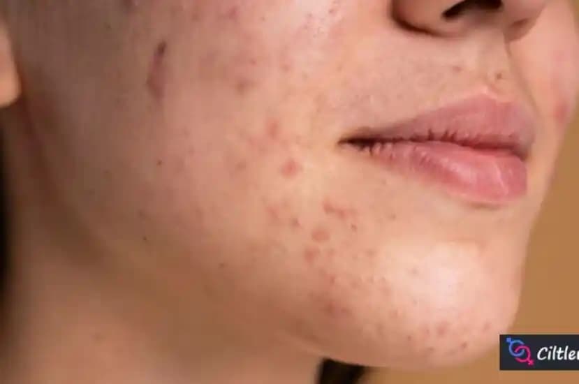 Ciltte Çıkan Yaraların Nedenleri ve Doğru Tedavi Yöntemleri