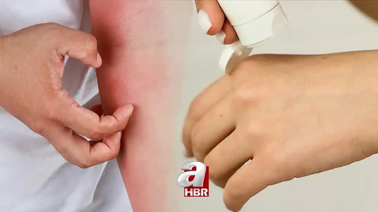 Ciltte Geçmeyen Kızarıklığın Nedenleri ve Etkili Tedavi Yöntemleri