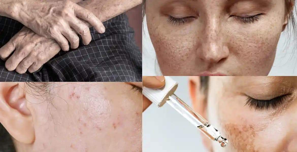 Ciltte Hiperpigmentasyon: Nedenleri, Çözümleri ve Günlük Bakım İpuçları