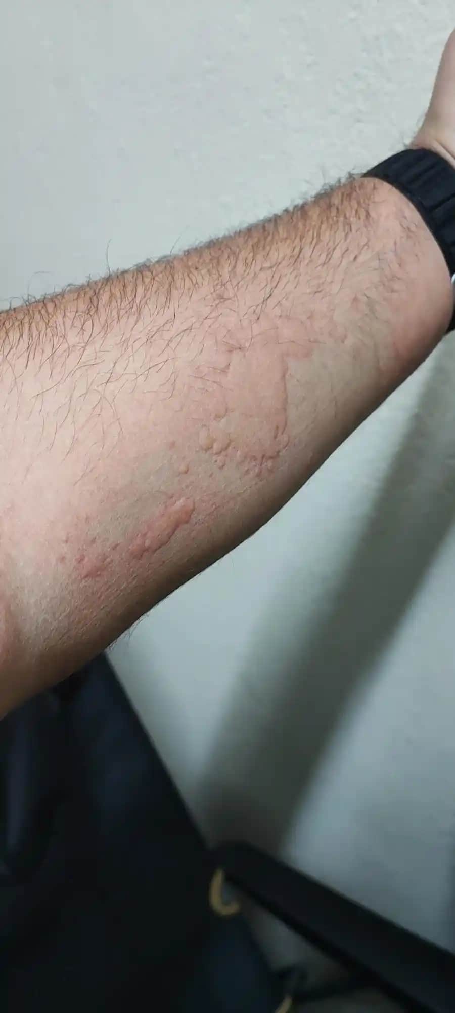 Ciltte Kabarma, Kaşıntı ve Kızarıklık Nedenleri ve Etkili Çözüm Yöntemleri