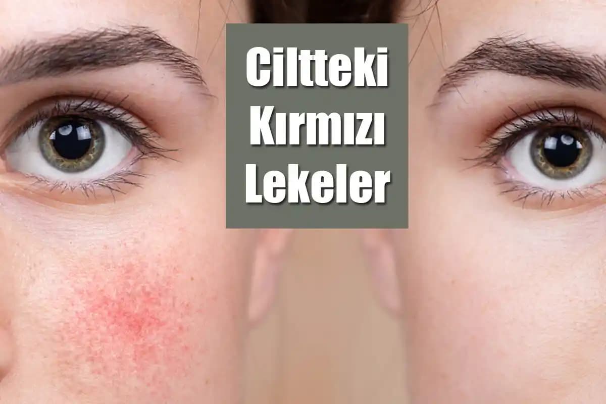 Ciltte Kırmızı Lekeler: Nedenleri, Tedavi Yöntemleri ve Koruma İpuçları