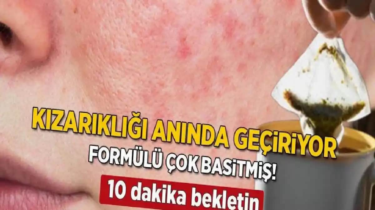 Ciltte Kızarıklık ve Kuruluk Sorunlarına Yönelik Etkili Bakım Yöntemleri ve Doğal Çözümler