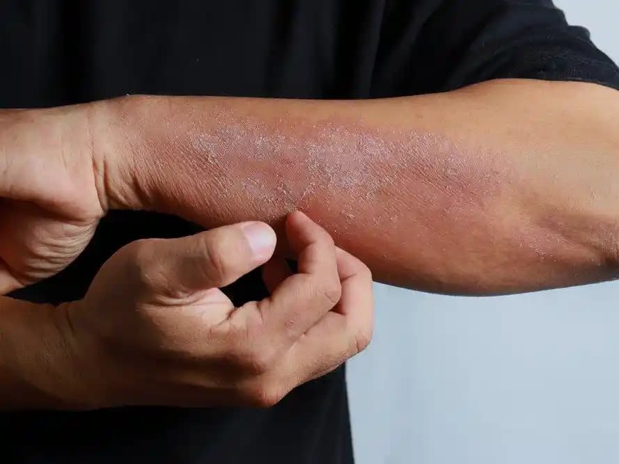 Ciltte Mantar Belirtileri, Tanı Yöntemleri ve Korunma Stratejileri Hakkında Bilgiler