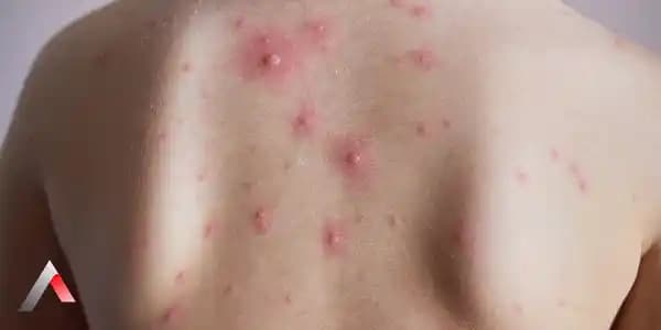 Ciltte Minik Kabarcıklar ve Kaşıntı: Nedenleri ve Etkili Çözüm Yolları