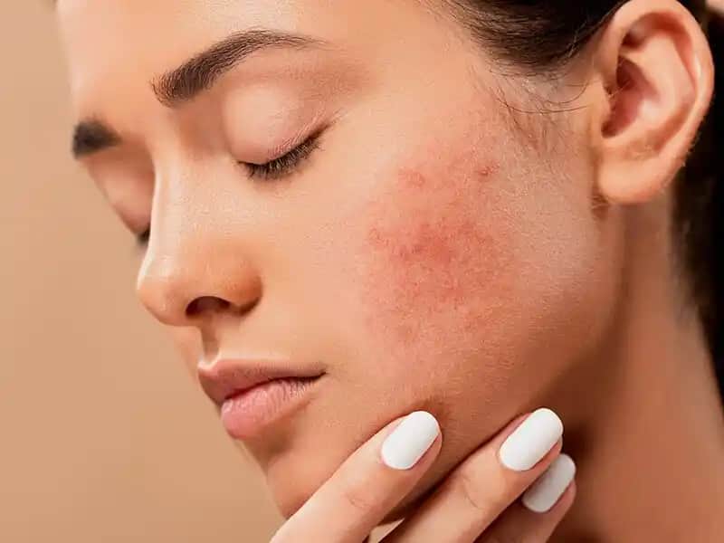 Ciltte Nokta Nokta Kabarma Nedenleri Belirtileri ve Çözüm Yolları