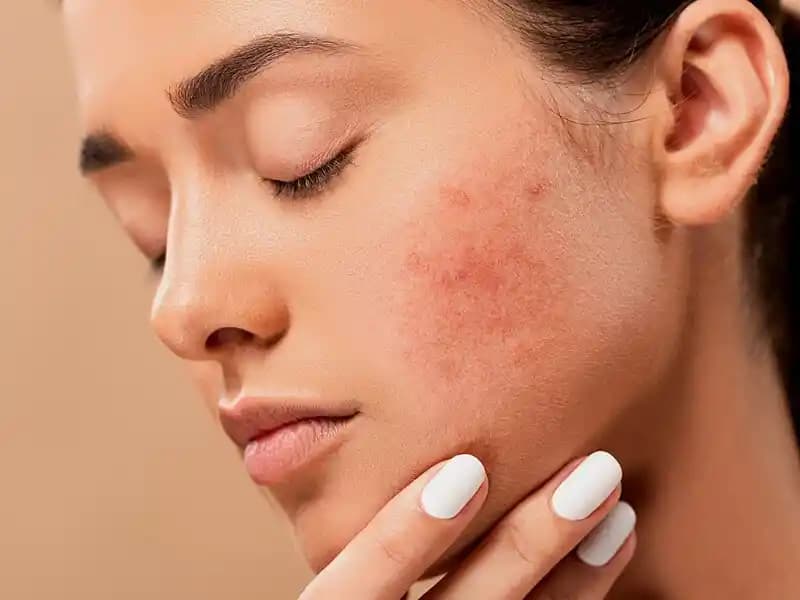 Ciltte Nokta Nokta Kabarma Nedenleri Belirtileri ve Çözüm Yolları