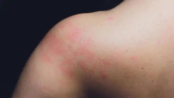 Ciltte Nokta Nokta Kızarıklıkların Nedenleri ve Etkili Çözüm Yolları