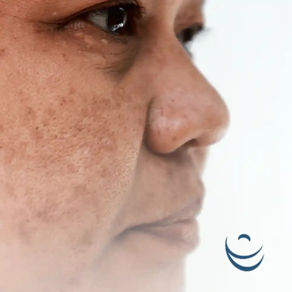 Ciltte Pembe Leke Nedenleri, Tedavi Yöntemleri ve Doğal Çözümler Hakkında Bilgiler