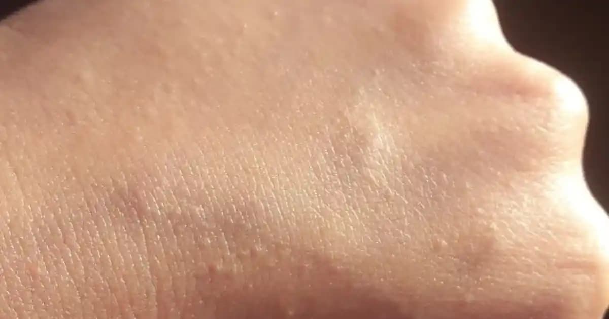 Ciltte Pütürcükler: Nedenleri, Önleme ve Etkili Tedavi Yöntemleri