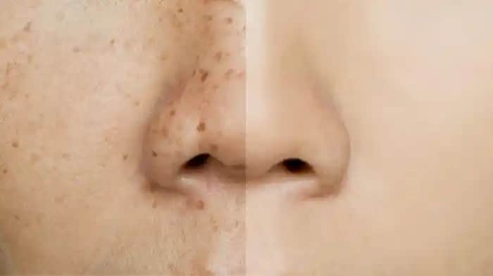 Ciltte Renk Değişikliği Nedenleri Türleri ve Etkili Çözüm Yolları