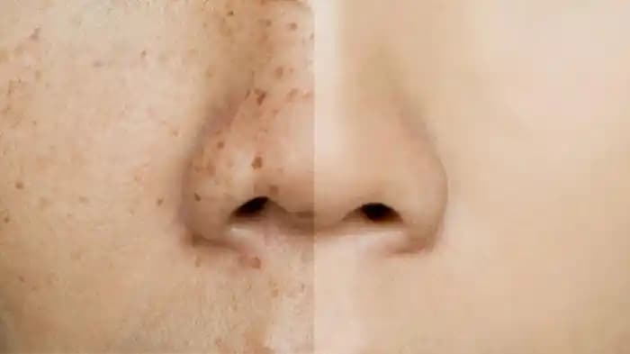 Ciltte Renk Değişikliği Nedenleri Türleri ve Etkili Çözüm Yolları