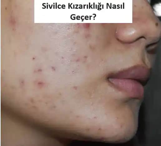 Ciltte Sivilce Benzeri Kızarıklıkların Nedenleri ve Etkili Çözüm Yöntemleri