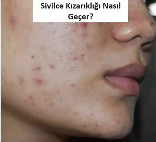 Ciltte Sivilce Benzeri Kızarıklıkların Nedenleri ve Etkili Çözüm Yöntemleri