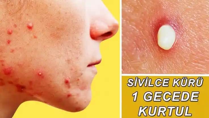 Ciltte Sivilcelerle Mücadele: Nedenleri, Çözümleri ve Koruyucu İpuçları