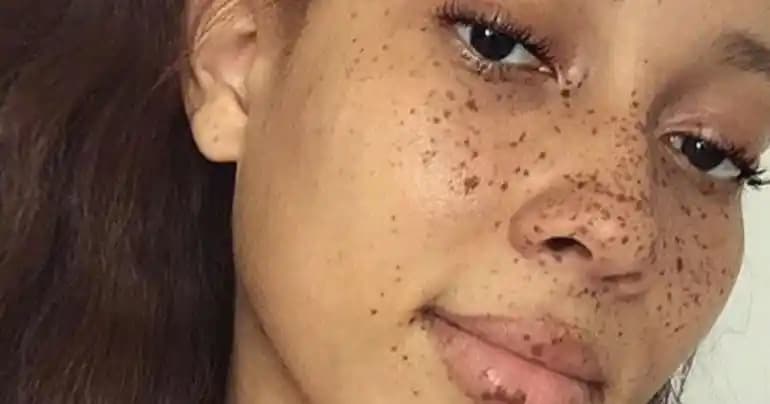 Ciltte Siyah Lekeler: Nedenleri, Tedavi Yöntemleri ve Önleme İpuçları