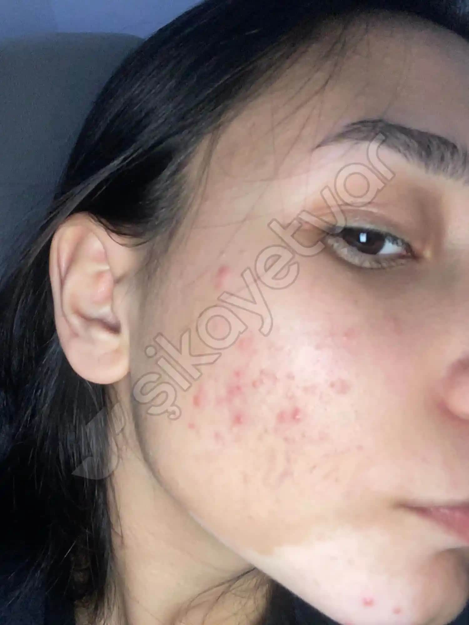 Ciltte Sürekli Sivilce Çıkmasının Nedenleri ve Çözüm Yolları Hakkında Kapsamlı Bilgi