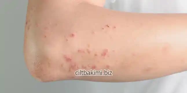 Ciltteki Kir Gibi Lekeleri Azaltmak İçin Etkili Kozmetik ve Doğal Çözüm Yolları