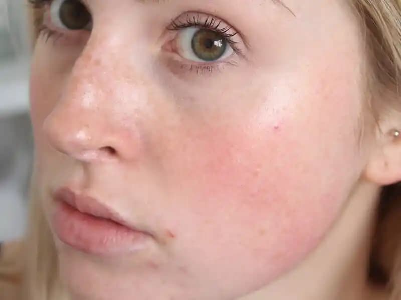 Ciltteki Kırmızı Lekelere Karşı Etkili Çözüm Yöntemleri ve Tedavi Seçenekleri