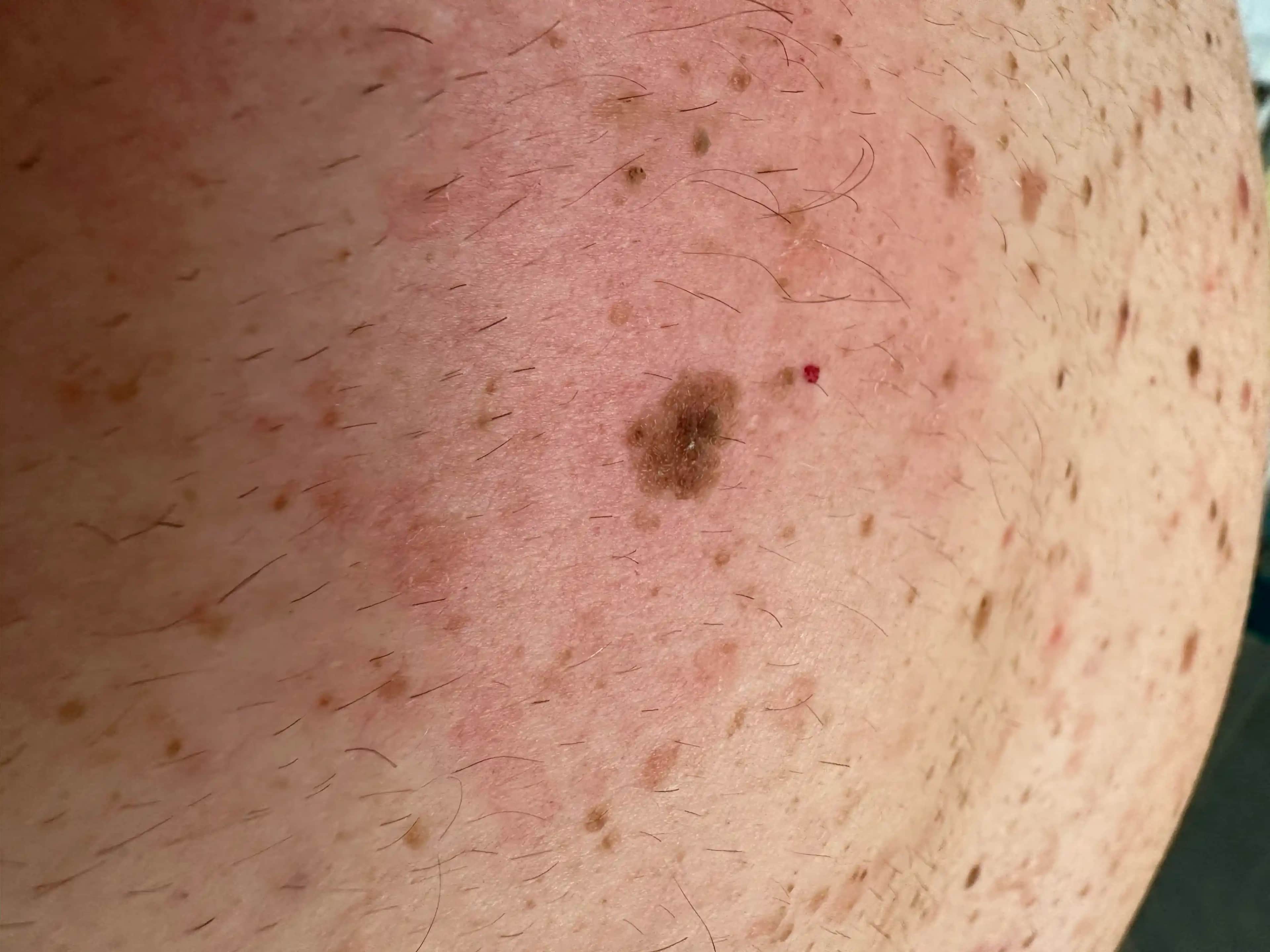 Ciltteki Lekeler ve Güzellik Sırları: Etkili Çözüm Yolları ve Profesyonel Tavsiyeler