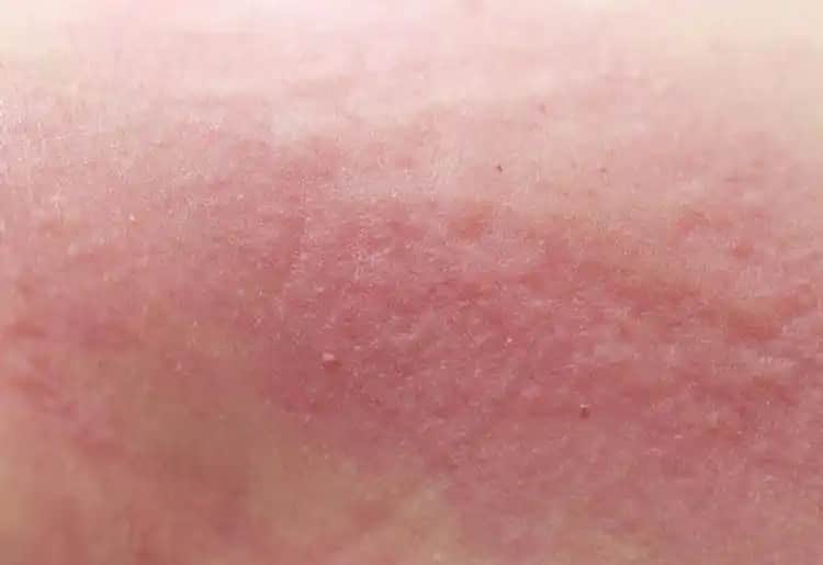 Ciltteki Lekelerin Nedenleri ve Etkili Korunma Yöntemleri