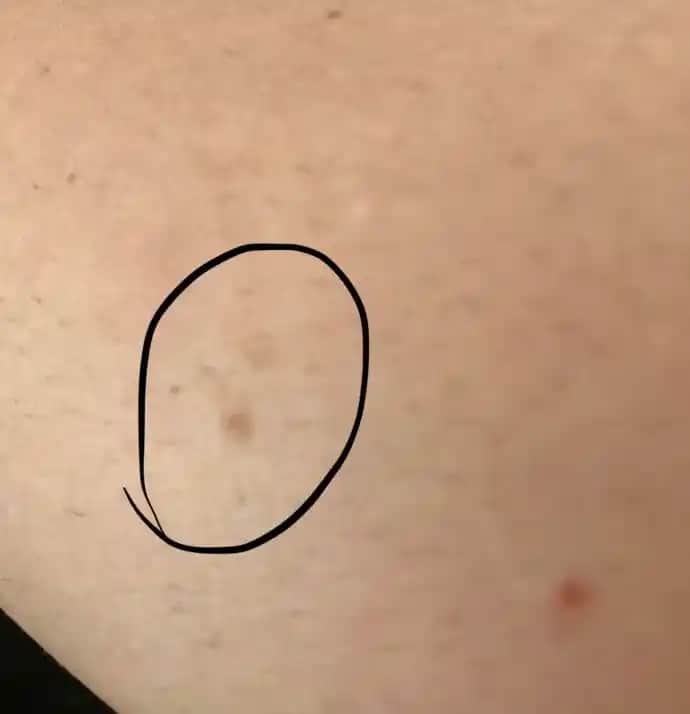 Ciltteki Lekelerle Mücadele ve Sağlıklı Cilt İçin Bilmeniz Gerekenler