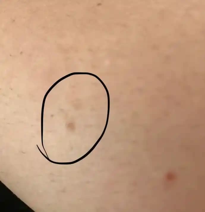 Ciltteki Lekelerle Mücadele ve Sağlıklı Cilt İçin Bilmeniz Gerekenler