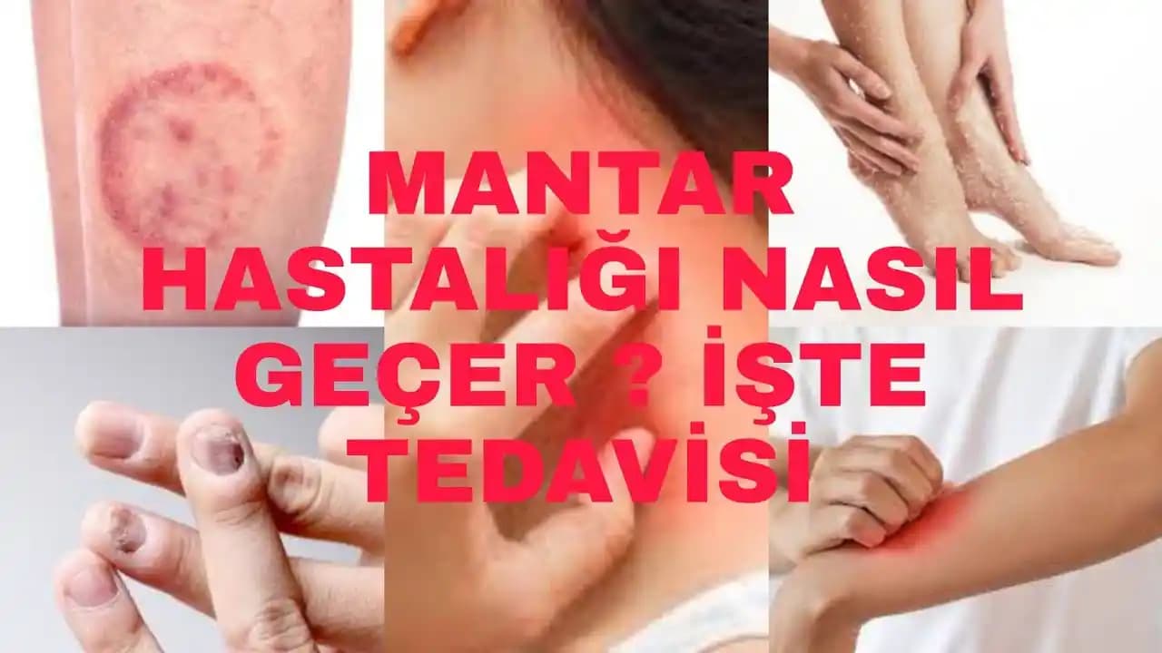 Ciltteki Mantar Nasıl Geçer? Etkili Tedavi ve Koruma Yöntemleri