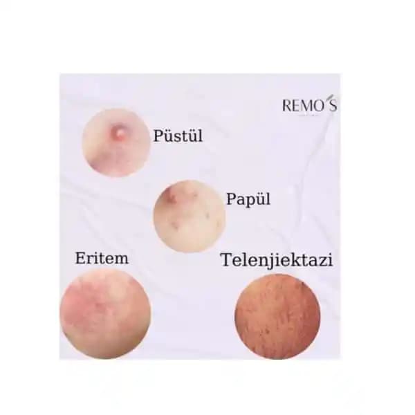 Ciltteki Papül, Püstül ve Sivilcelerin Anlamı ve Etkili Çözüm Yolları